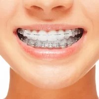Aligners 1