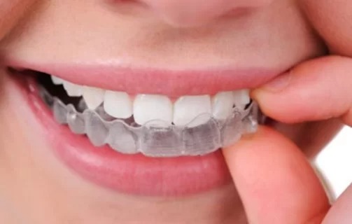 Invisible Braces