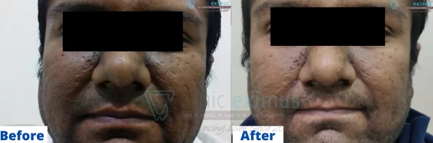 Skin Whitening Treatment Before & After
