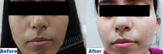 Skin Whitening Treatment Before & After