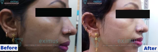 Skin Whitening Treatment Before & After