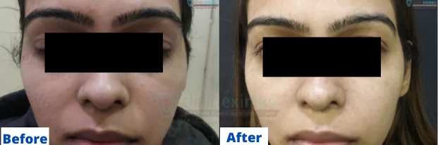 Skin Whitening Treatment Before & After