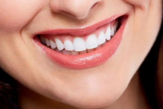 Smile Makeover