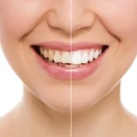 Teeth white