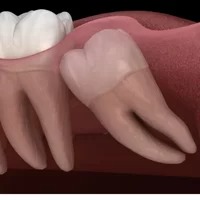 dental Wisdom Tooth